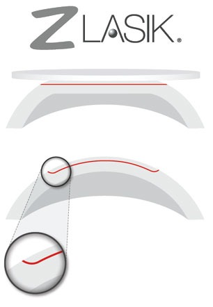 Z-LASIK Femtosekundenlaser