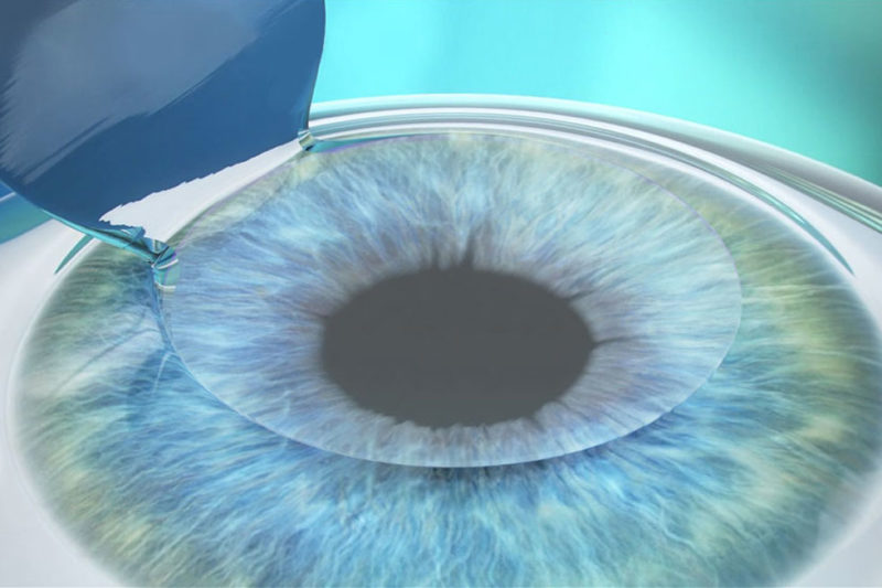 LASIK: 2. Generation des Augenlaserns